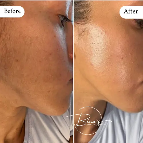 Bina's Advanced Aesthetics Dermaplanning Before_After A in Melbourne, FL