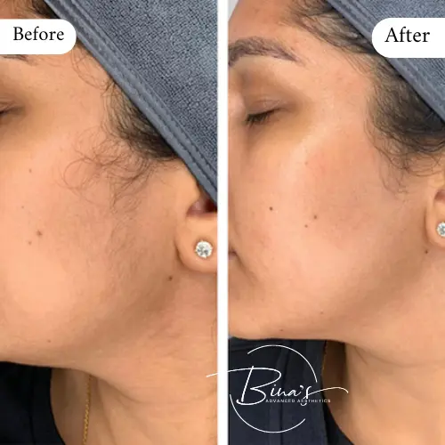 Bina's Advanced Aesthetics Dermaplanning Before_After B in Melbourne, FL