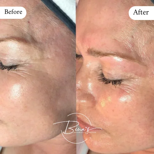 Bina's Advanced Aesthetics HydraFacial Before_After A in Melbourne, FL