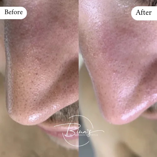 Bina's Advanced Aesthetics HydraFacial Before_After B in Melbourne, FL