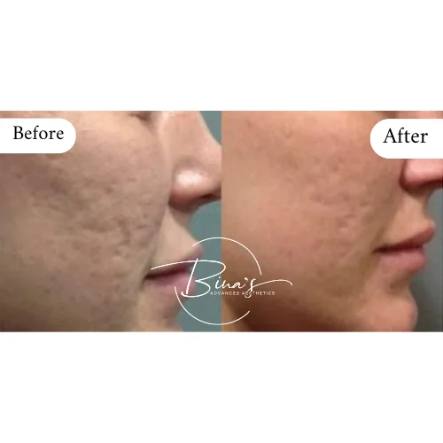 Bina's Advanced Aesthetics Microneedling Before_After A in Melbourne, FL