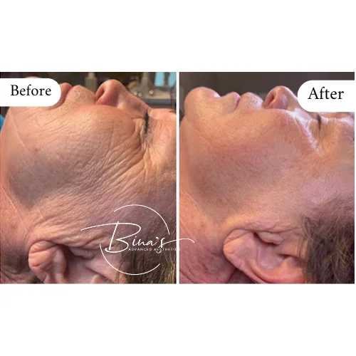 Bina's Advanced Aesthetics Microneedling Before_After B in Melbourne, FL