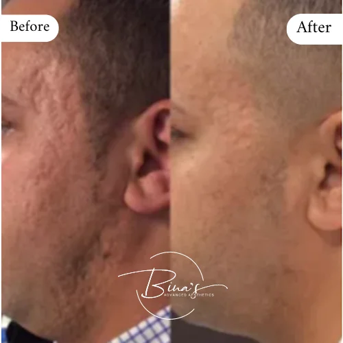 Bina's Advanced Aesthetics Microneedling Before_After D in Melbourne, FL