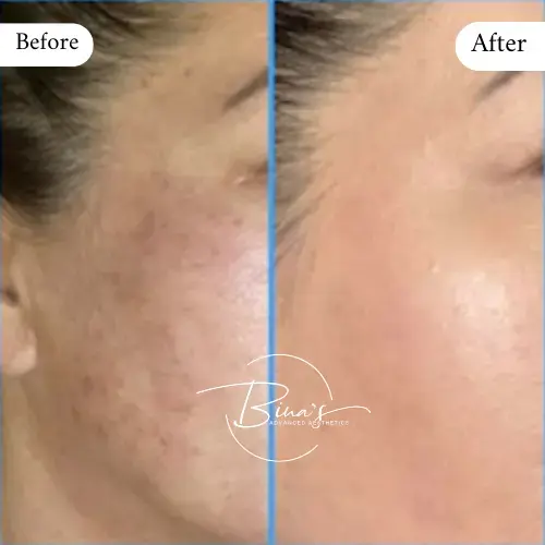 Bina's-Advanced-Aesthetics-BioRePeel-Before_After-A-in-Melbourne-FL