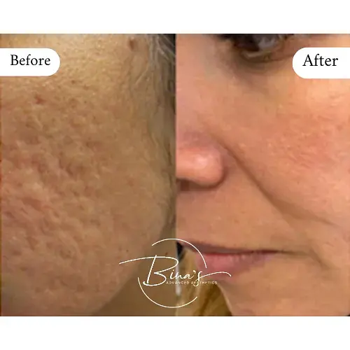 Bina's-Advanced-Aesthetics-Microneedling-Before_After-new-in-Melbourne-FL