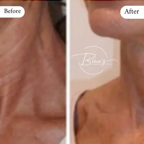 Bina's Advanced Aesthetics BioRePeel Before_After B in Melbourne, FL