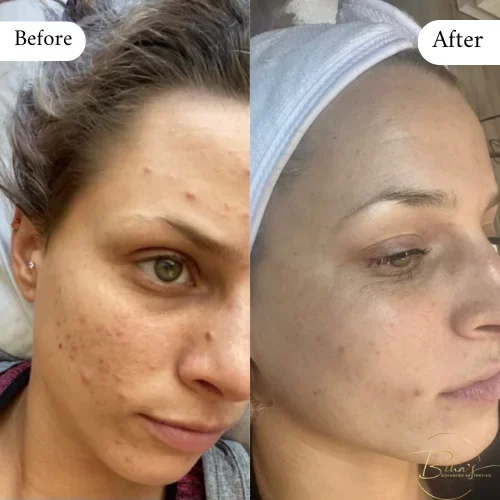 Bina's Advanced Aesthetics FaceReality Bootcamp Before_After B in Melbourne, FL