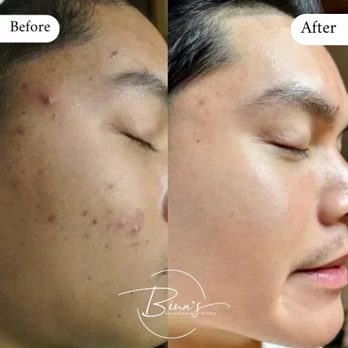 Bina's Advanced Aesthetics FaceReality Bootcamp Before_After C in Melbourne, FL