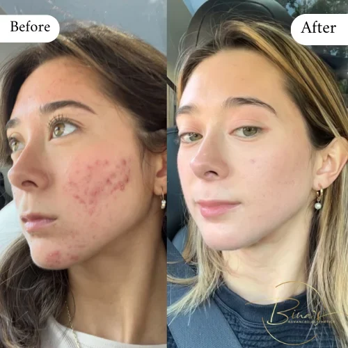 Bina's Advanced Aesthetics FaceReality Bootcamp Before_After D in Melbourne, FL