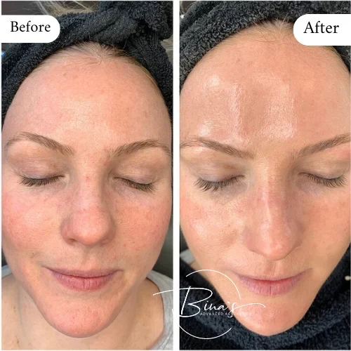 Bina's Advanced Aesthetics HydraFacial Before_After C in Melbourne, FL