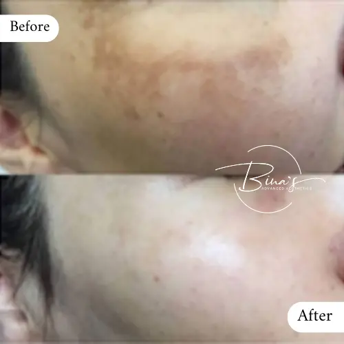 Bina's Advanced Aesthetics BioRePeel Before_After C in Melbourne, FL